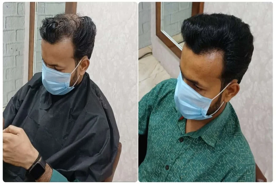 6 Side Effects of Wearing A Hair Patch In Delhi And How To Minimize Them Hair Patch